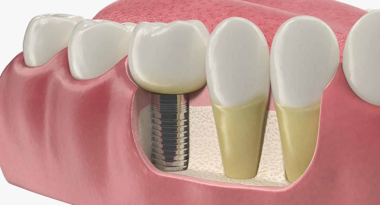 3D Teeth Tongue Medical Model With Dental Implant