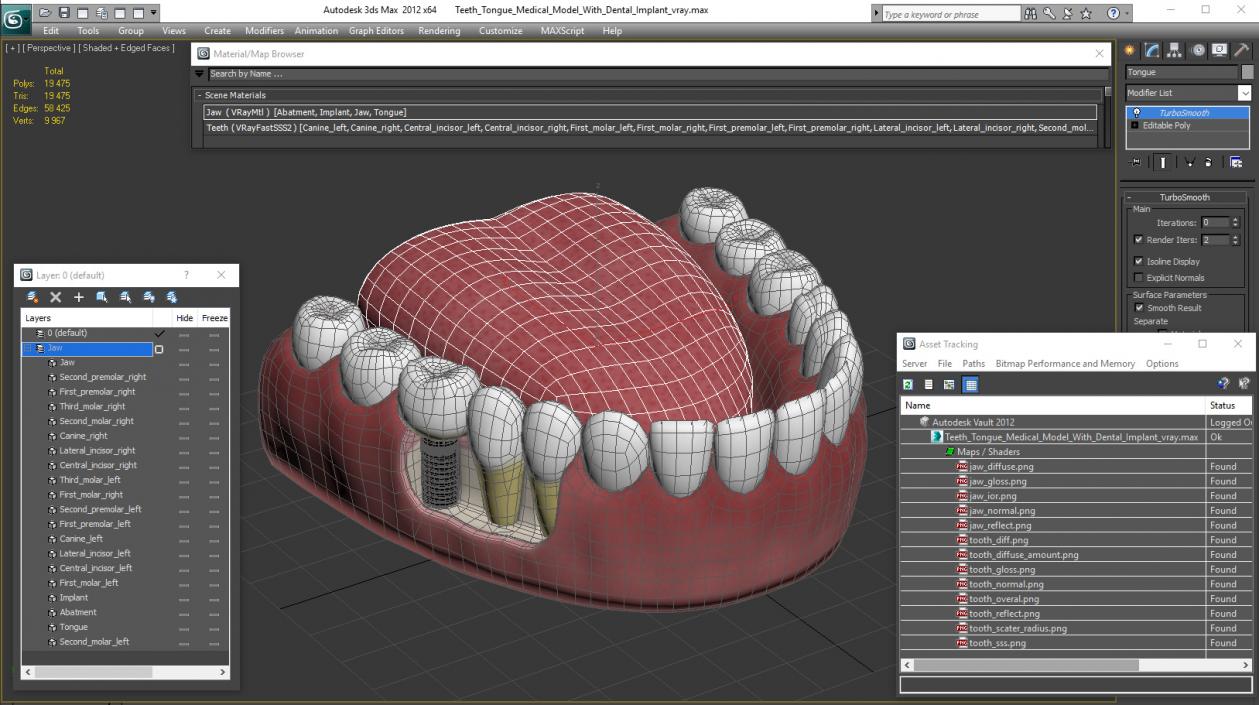 3D Teeth Tongue Medical Model With Dental Implant