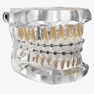 3D model Transparent Dental Typodont With Bracket and Dental Implants