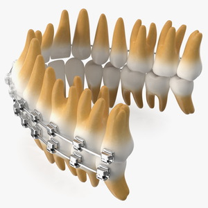 Ligature-Free Braces on Plastic Teeth 3D