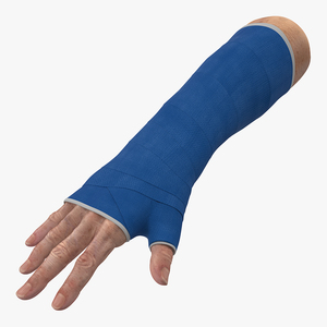 3D Fiberglass Cast Wrist