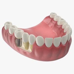 3D model Lower Teeth Medical Model With Dental Implant