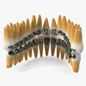 3D Lingual Braces on Teeth model