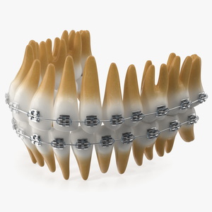 3D model Ligature Braces on Artificial Teeth