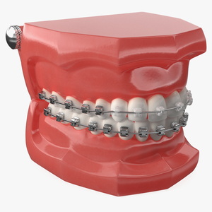 3D Ligature-Free Braces on Artificial Jaw model