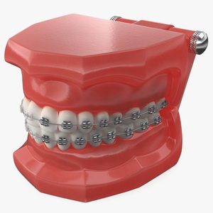 3D model Ligature Braces on Teeth Model