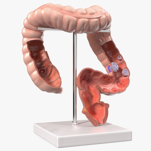 Medical Model Diseased Intestine 3D