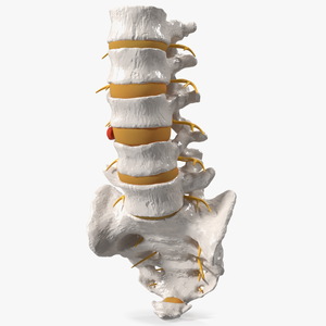 3D model Spinal Column with Hernia