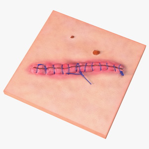 Skin with Medical Seam Open 3D