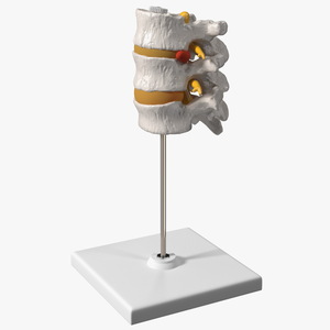 3D Herniated Vertebrae on Medical Stand